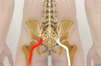 Хирурги, с уважением: «Защемление седалищного нерва не требует медикаментов!