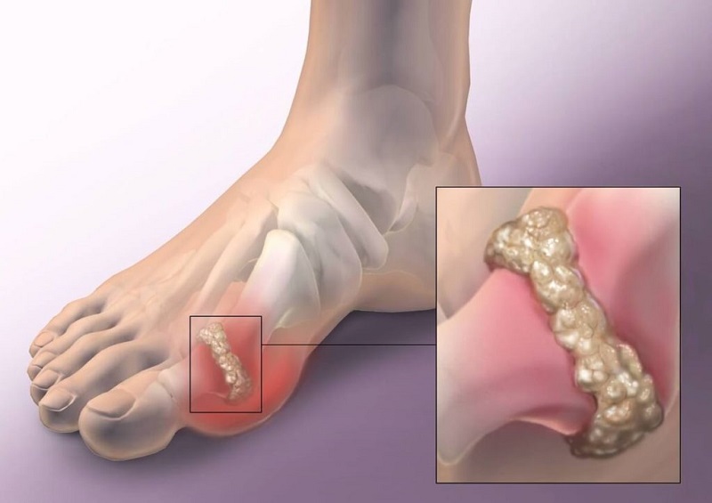 Подагра, стоп! Как всего 1 средство поможет избавиться от боли и внешних признаков.