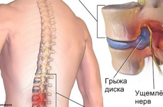 Знакомый хирург посоветовал мне эту зарядку вместо операции. И правда помогло!
