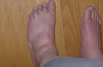 Устранение мочевой кислоты в суставах с использованием этих 8 природных средств