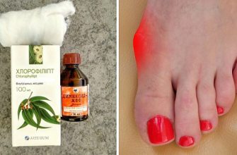 Косточка больше не болит! Потратила мелкие деньги на 2 средства, эффект невероятен.