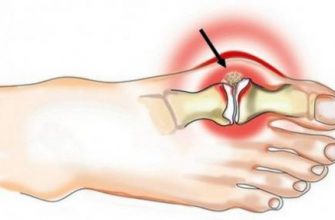 Метод Штаба: Как убрать шишки на ногах
