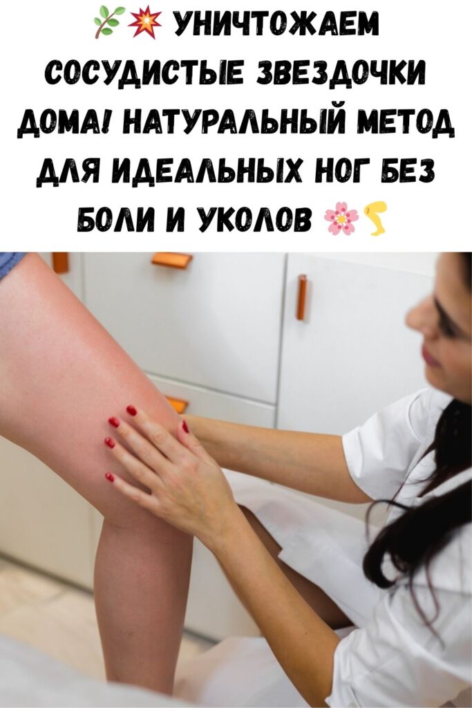 Уничтожаем «СОСУДИСТЫЕ ЗВЕЗДОЧКИ» на ногах без операций и лекарств!