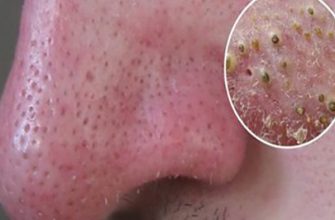 У вас есть прыщи на лице? Избавьтесь от них, естественно и быстро!