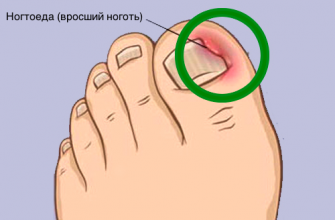 Как правильно решить проблему вросших ногтей и что такое ногтоеда?