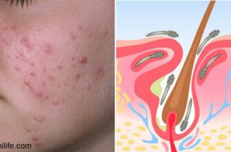 Как выглядит подкожный клещ и его симптомы