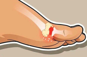 10 ПРОДУКТОВ РАСТВОРЯТ КРИСТАЛЛЫ МОЧЕВОЙ КИСЛОТЫ И ИЗБАВЯТ ОТ ПОДАГРЫ, КАМНЕЙ В ПОЧКАХ, БОЛЕЙ В СУСТАВАХ!