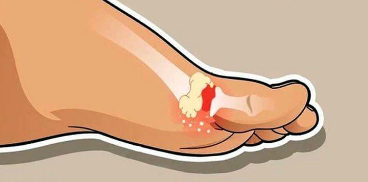 10 ПРОДУКТОВ РАСТВОРЯТ КРИСТАЛЛЫ МОЧЕВОЙ КИСЛОТЫ И ИЗБАВЯТ ОТ ПОДАГРЫ, КАМНЕЙ В ПОЧКАХ, БОЛЕЙ В СУСТАВАХ!