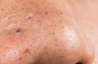 Чудо-маска с легкостью уберет ненавистные черные точки! И даже усики ей под силу Готовим дома