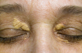 Болезнь сердца: 10 тревожных симптомов, которые будут видны на коже