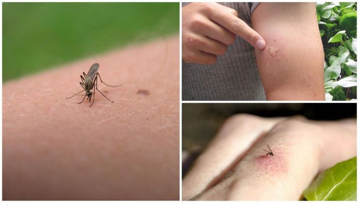 Как лечить укусы комаров: 2 популярных способа