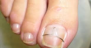 Почему врастают ногти? Причины и методы лечения этой болезни.