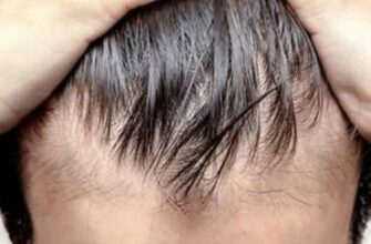 Растительные средства для лечения облысения, выпадения волос или алопеции