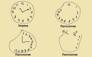 Как проверить себя на болезнь Альцгеймера Как проверить себя на болезнь Альцгеймера